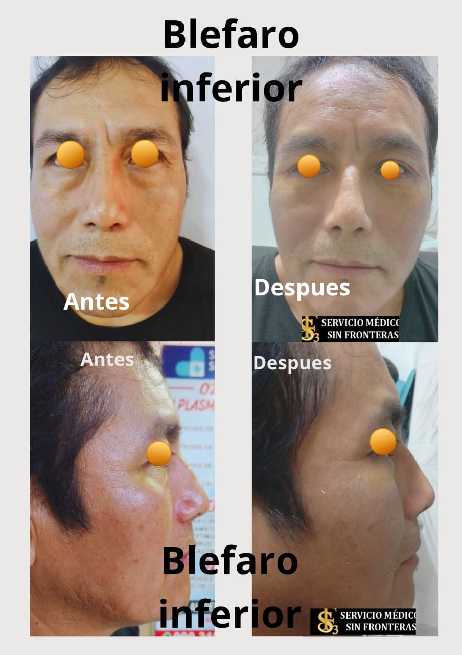 Blefaroplastia